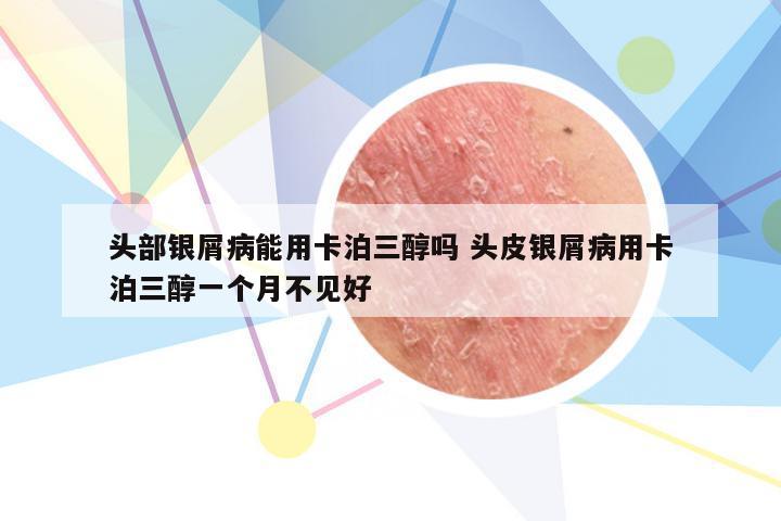 头部银屑病能用卡泊三醇吗 头皮银屑病用卡泊三醇一个月不见好