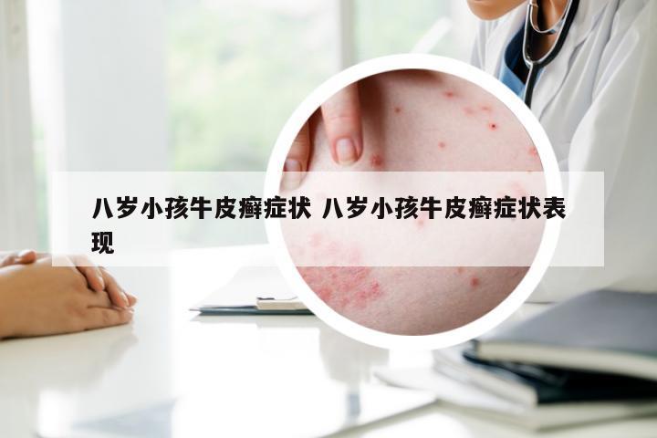 八岁小孩牛皮癣症状 八岁小孩牛皮癣症状表现