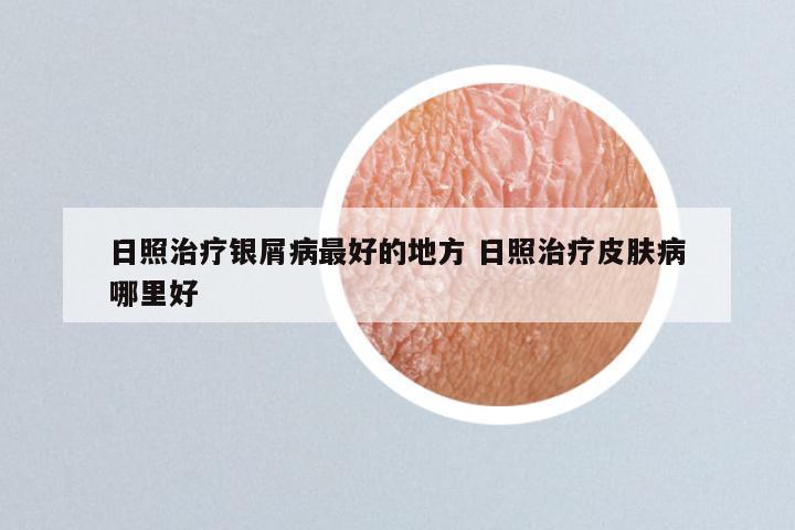 日照治疗银屑病最好的地方 日照治疗皮肤病哪里好