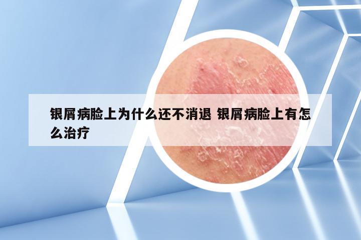 银屑病脸上为什么还不消退 银屑病脸上有怎么治疗