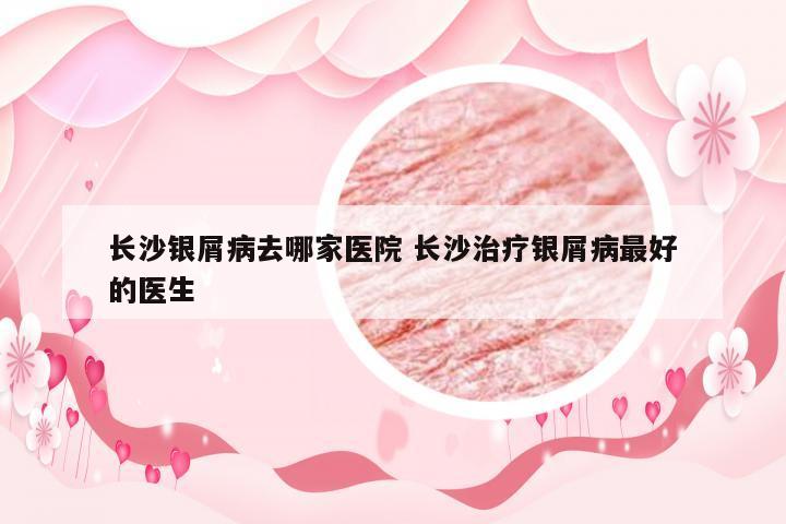 长沙银屑病去哪家医院 长沙治疗银屑病最好的医生