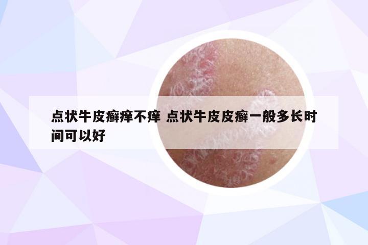 点状牛皮癣痒不痒 点状牛皮皮癣一般多长时间可以好