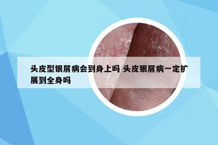 头皮型银屑病会到身上吗 头皮银屑病一定扩展到全身吗