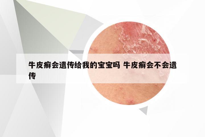 牛皮癣会遗传给我的宝宝吗 牛皮癣会不会遗传