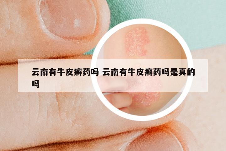 云南有牛皮癣药吗 云南有牛皮癣药吗是真的吗
