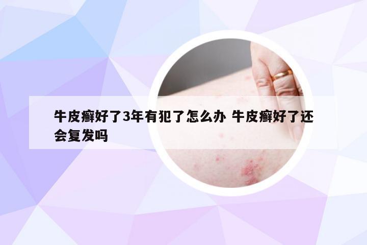牛皮癣好了3年有犯了怎么办 牛皮癣好了还会复发吗