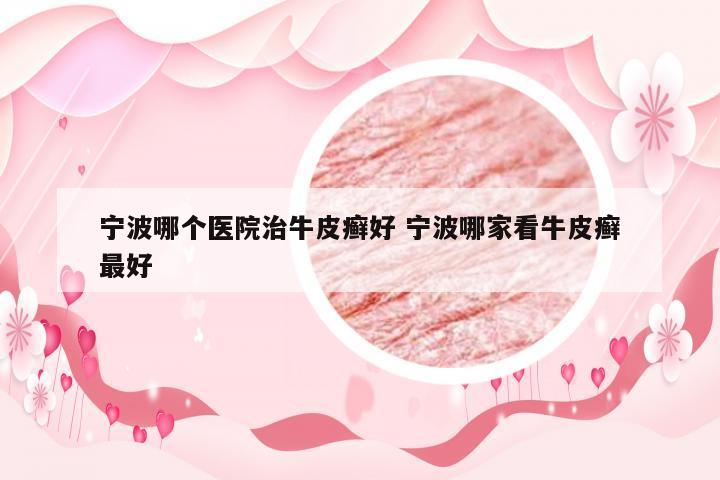宁波哪个医院治牛皮癣好 宁波哪家看牛皮癣最好
