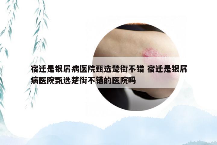 宿迁是银屑病医院甄选楚街不错 宿迁是银屑病医院甄选楚街不错的医院吗