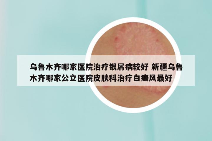 乌鲁木齐哪家医院治疗银屑病较好 新疆乌鲁木齐哪家公立医院皮肤科治疗白癜风最好