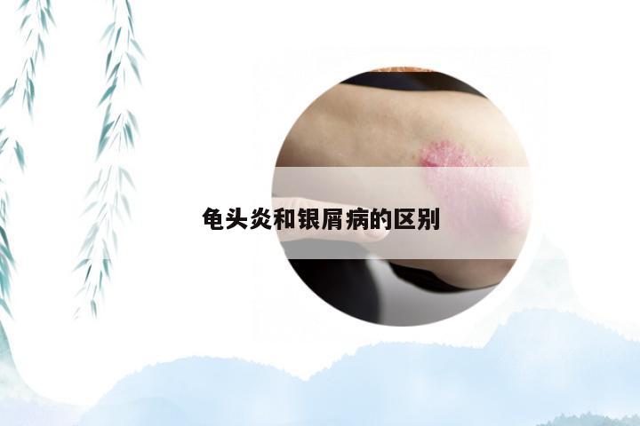 龟头炎和银屑病的区别
