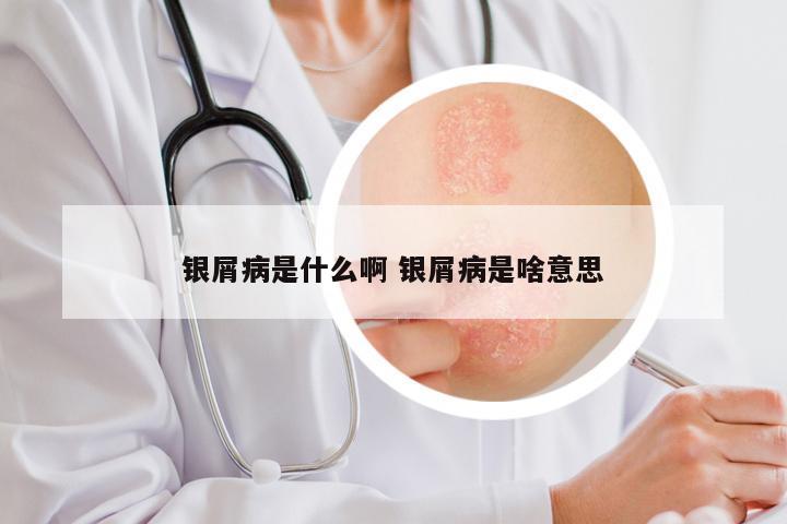 银屑病是什么啊 银屑病是啥意思