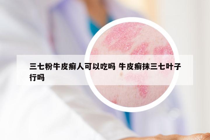 三七粉牛皮癣人可以吃吗 牛皮癣抹三七叶子行吗