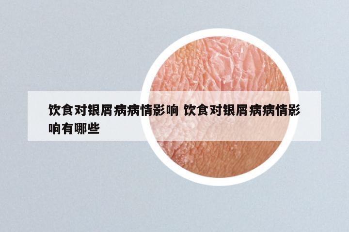 饮食对银屑病病情影响 饮食对银屑病病情影响有哪些