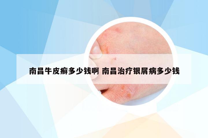 南昌牛皮癣多少钱啊 南昌治疗银屑病多少钱
