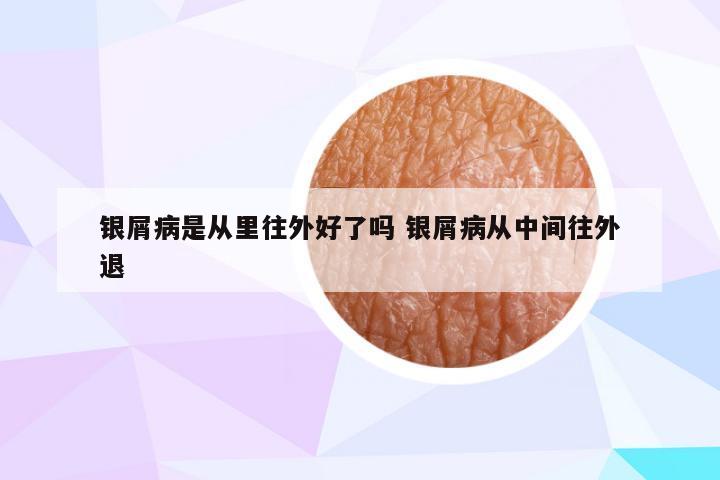 银屑病是从里往外好了吗 银屑病从中间往外退