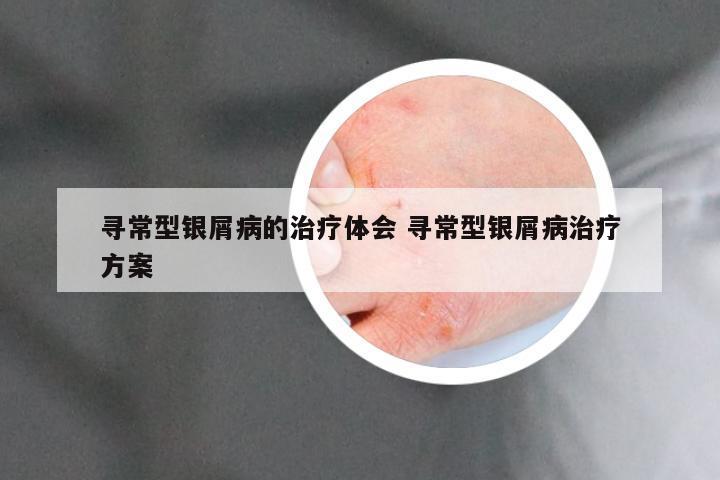 寻常型银屑病的治疗体会 寻常型银屑病治疗方案