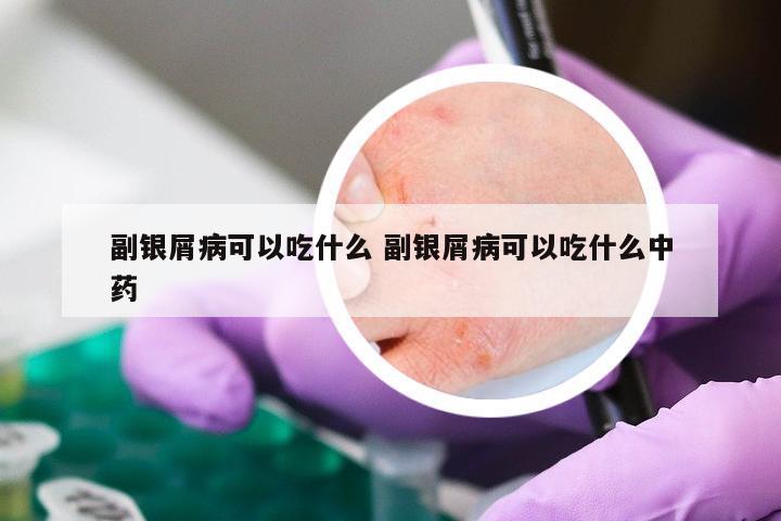 副银屑病可以吃什么 副银屑病可以吃什么中药