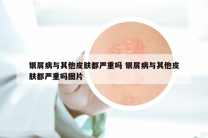 银屑病与其他皮肤都严重吗 银屑病与其他皮肤都严重吗图片