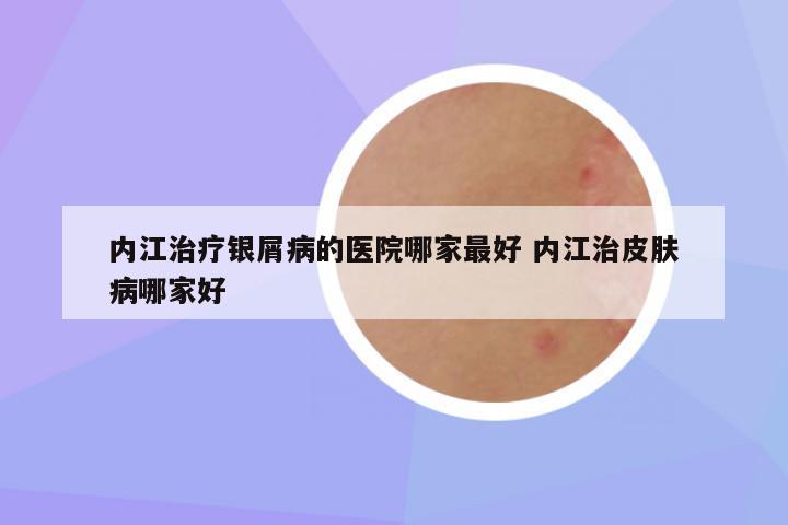 内江治疗银屑病的医院哪家最好 内江治皮肤病哪家好