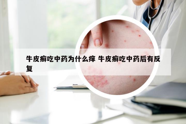 牛皮癣吃中药为什么痒 牛皮癣吃中药后有反复