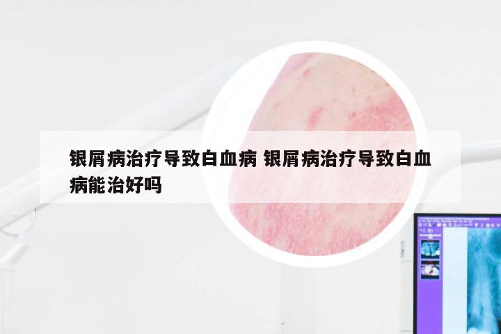 银屑病治疗导致白血病 银屑病治疗导致白血病能治好吗