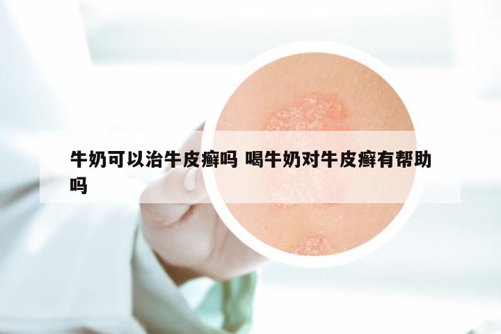 牛奶可以治牛皮癣吗 喝牛奶对牛皮癣有帮助吗