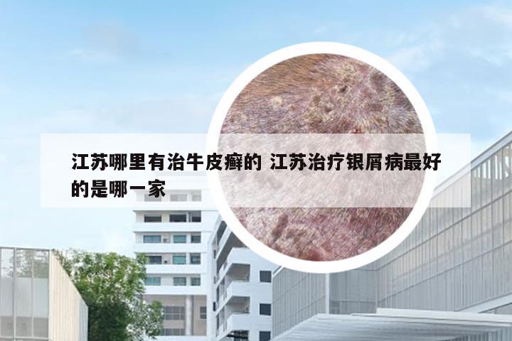 江苏哪里有治牛皮癣的 江苏治疗银屑病最好的是哪一家