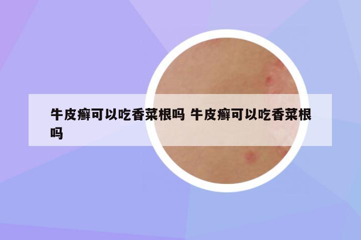 牛皮癣可以吃香菜根吗 牛皮癣可以吃香菜根吗
