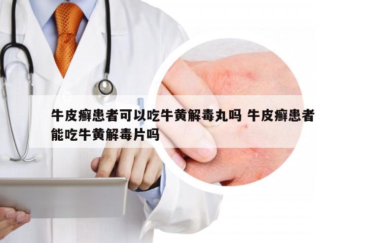 牛皮癣患者可以吃牛黄解毒丸吗 牛皮癣患者能吃牛黄解毒片吗
