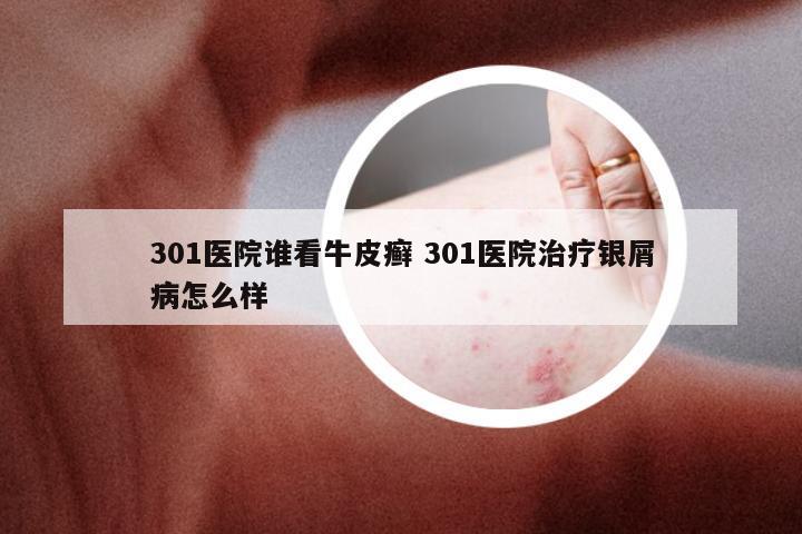 301医院谁看牛皮癣 301医院治疗银屑病怎么样