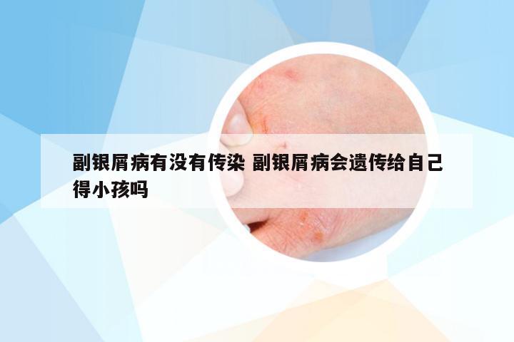 副银屑病有没有传染 副银屑病会遗传给自己得小孩吗