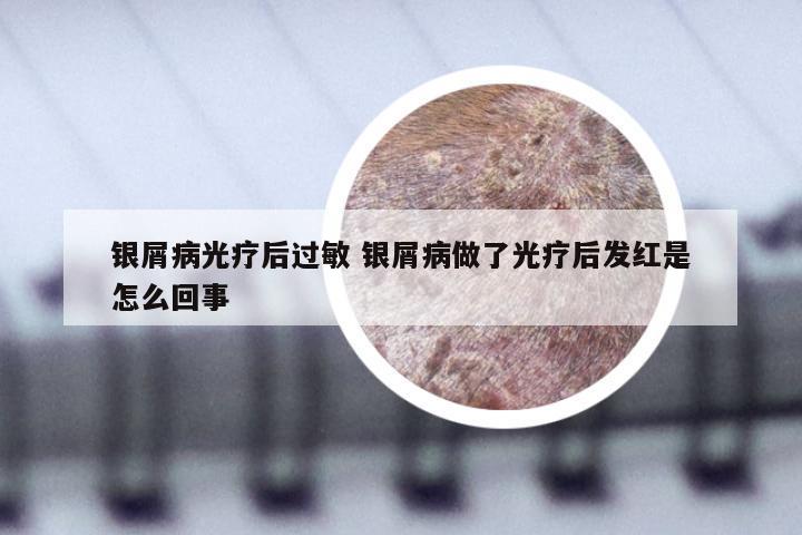 银屑病光疗后过敏 银屑病做了光疗后发红是怎么回事