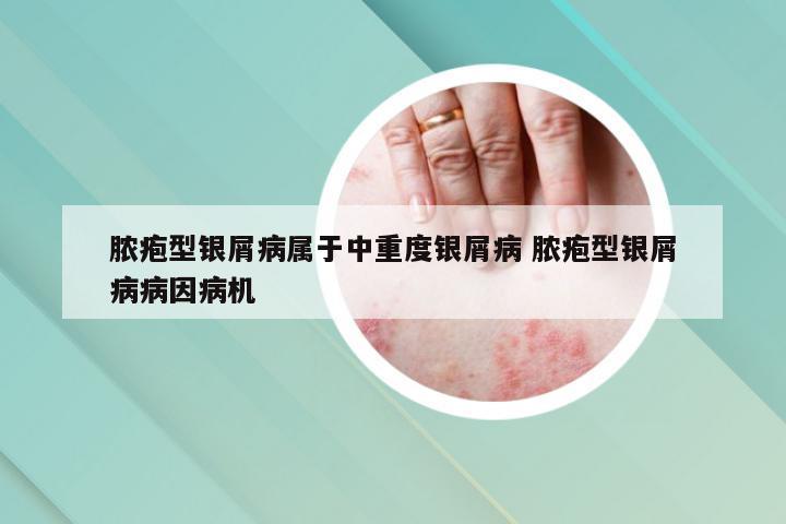 脓疱型银屑病属于中重度银屑病 脓疱型银屑病病因病机