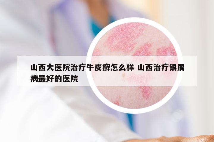 山西大医院治疗牛皮癣怎么样 山西治疗银屑病最好的医院