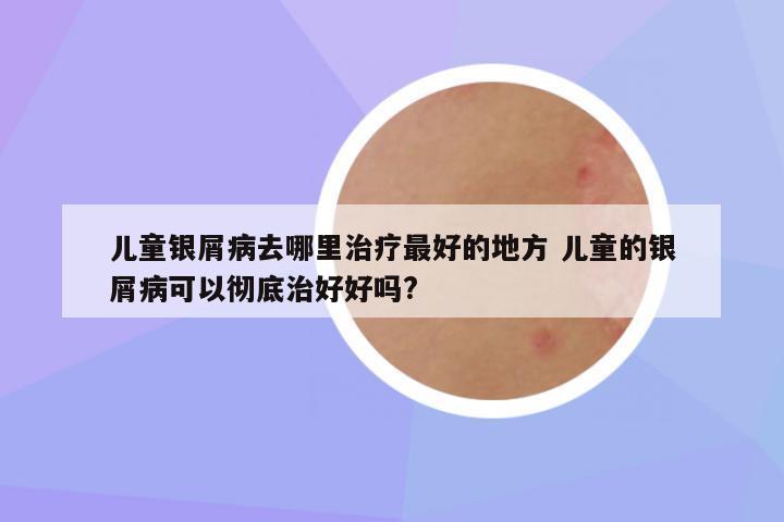 儿童银屑病去哪里治疗最好的地方 儿童的银屑病可以彻底治好好吗?