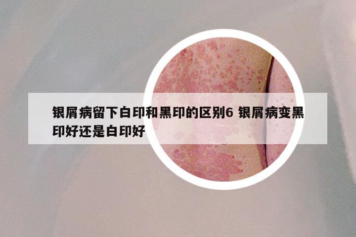 银屑病留下白印和黑印的区别6 银屑病变黑印好还是白印好