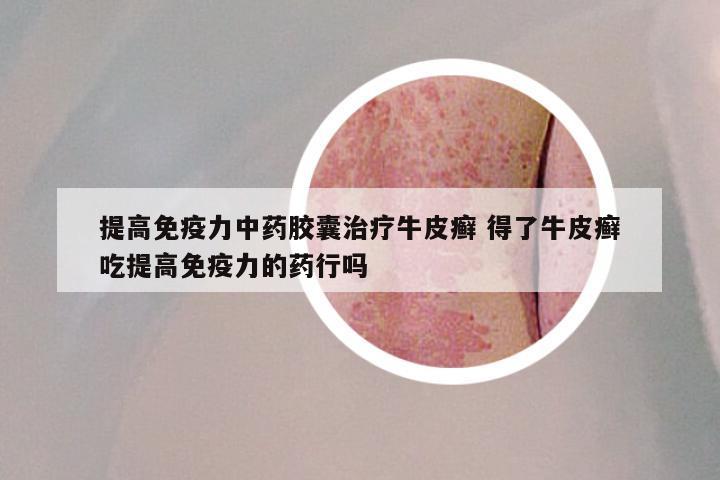 提高免疫力中药胶囊治疗牛皮癣 得了牛皮癣吃提高免疫力的药行吗
