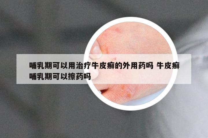 哺乳期可以用治疗牛皮癣的外用药吗 牛皮癣哺乳期可以擦药吗