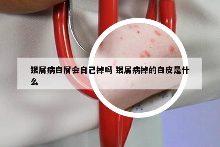 银屑病白屑会自己掉吗 银屑病掉的白皮是什么