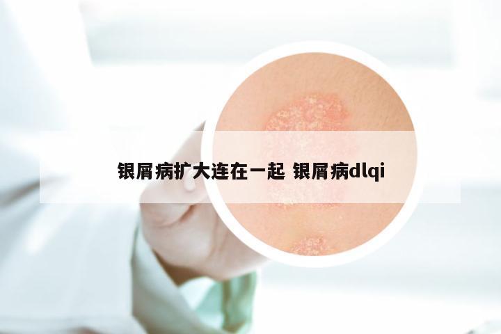 银屑病扩大连在一起 银屑病dlqi