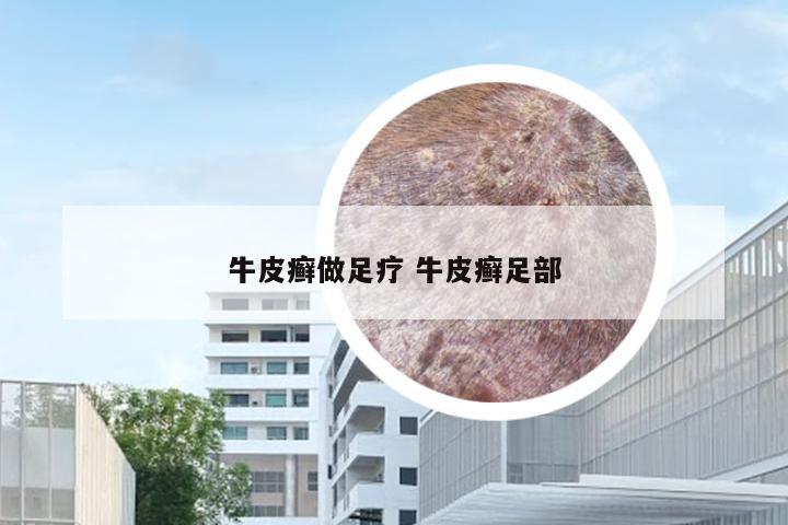 牛皮癣做足疗 牛皮癣足部
