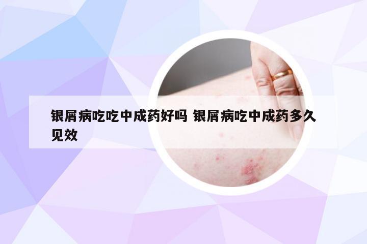 银屑病吃吃中成药好吗 银屑病吃中成药多久见效