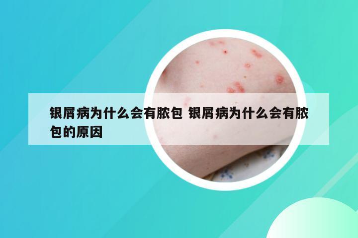 银屑病为什么会有脓包 银屑病为什么会有脓包的原因