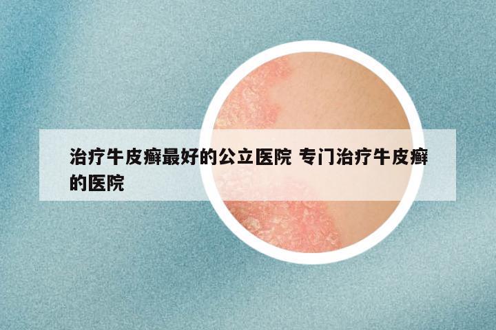 治疗牛皮癣最好的公立医院 专门治疗牛皮癣的医院