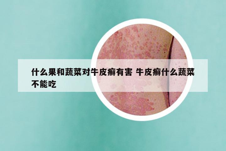 什么果和蔬菜对牛皮癣有害 牛皮癣什么蔬菜不能吃