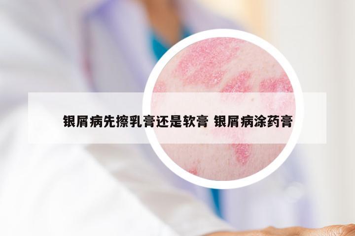 银屑病先擦乳膏还是软膏 银屑病涂药膏