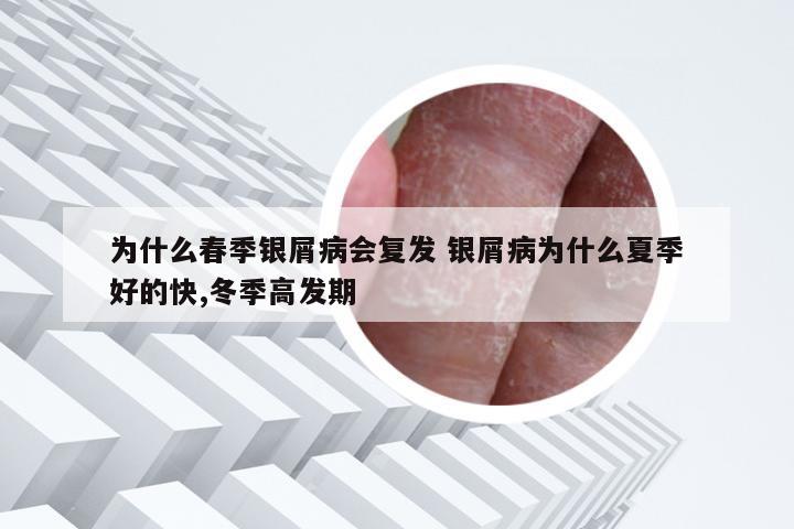 为什么春季银屑病会复发 银屑病为什么夏季好的快,冬季高发期