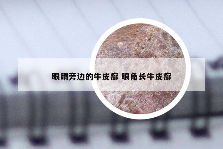 眼睛旁边的牛皮癣 眼角长牛皮癣