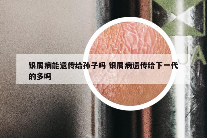 银屑病能遗传给孙子吗 银屑病遗传给下一代的多吗