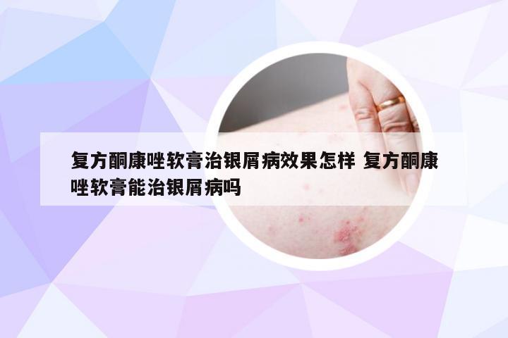 复方酮康唑软膏治银屑病效果怎样 复方酮康唑软膏能治银屑病吗